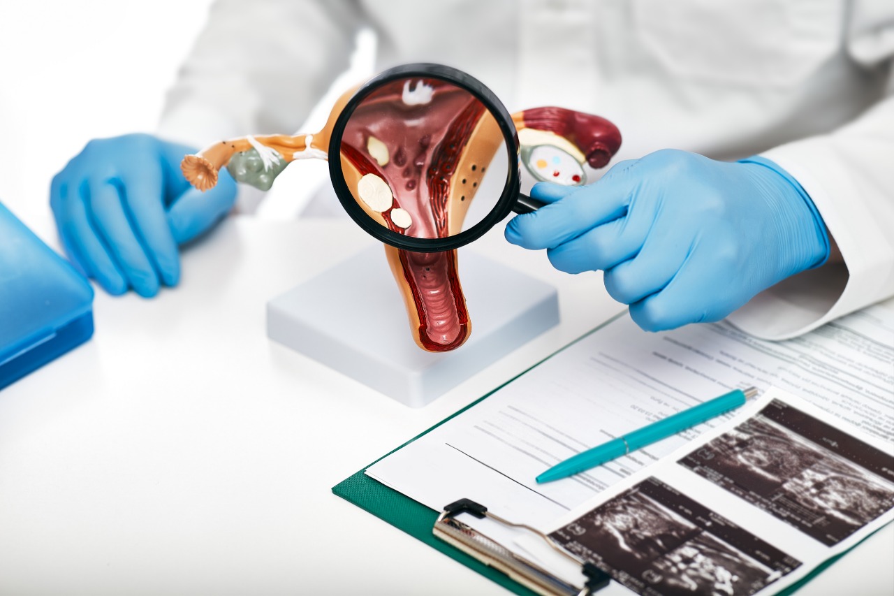 Endometriose tem cura? Conheça os tratamentos