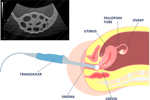 Ultrassom Transvaginal e Pélvico